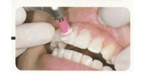 歯の着色除去に歯医者でクリーニングする